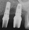 Fig 3. Examples of implants with different thread designs. On the left is an implant with standard v-threads, and on the right is an implant with larger, more aggressive threads. The implant on the right was inserted with 20-Ncm-greater insertion torque than its counterpart.