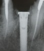 Fig 5. Radiograph of the implant at site No. 28 (shown in Figure 4) with an oversized cover screw, which was used to assist in stabilizing the implant within the osteotomy.