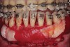 Fig 5. Bone grafting complete. Collagen wound dressing in place for graft stabilization and autogenous connective tissue grafts in
place, teeth Nos. 21 and 22 and Nos. 27 and 28, for simultaneous soft-tissue augmentation.