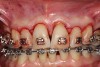 Fig 15. Papilla preservation design incisions, teeth Nos. 7 and 8 and Nos. 9 and 10. The Takei papilla preservation incision design has been used at teeth Nos. 8 and 9.