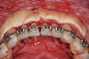 Fig 16. Particulate bone grafting performed to augment deficient dentoalveolar bone and acellular dermal matrix used as a barrier.