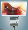 Fig 3. The dental videoscope is the only dental visualization instrument that places a very small, high-definition digital camera into the surgical site. Unlike the glass fiber endoscope, the electronic signal from the camera gives a clear and clinically accurate image on the surgical monitor.