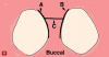 Fig 6. The incision pattern for VMIS on natural teeth is illustrated. Incisions A and B are separate sulcular incisions. These incisions should not be continuous, as commonly used in traditional periodontal surgery. Incision C is a split-thickness incision that is made close to the base of the papilla. In almost all cases, these incisions are made on the lingual. This approach leaves the esthetically sensitive buccal papilla undisturbed with no incision or reflection.