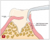 Fig 7. The split-thickness incision used on the lingual (incision C) is illustrated. This approach allows access for the videoscope while leaving the buccal papilla and interproximal col tissue intact and unreflected. By leaving this tissue undisturbed, postsurgical recession can be avoided.