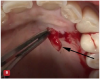 Fig 9. The VMIS procedure for peri-implant bone loss incorporates the removal of a thin piece of connective tissue that has been in direct contact with the implant in the area of bone loss. The removal of this tissue is similar to the harvesting of a connective tissue graft and is shown in the photograph (arrow). This is done to remove microscopic foreign bodies of cement and/or titanium particles that are associated with peri-implantitis.
