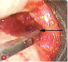 Fig 10. The removal of granulation tissue with a Younger-Goode 7/8 curette being used in a spoon motion is illustrated. The arrow points to the tip of the curette placed into the bony defect. The granulation tissue is removed in a fashion similar to the use of a caries spoon to remove caries.