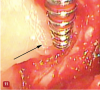 Fig 11. A straight bone file can be used to remove calculus from the root surface. The narrow diameter and length of this instrument is ideal for reaching deeper areas through the small VMIS access opening. A bone file should be used with care to avoid damage to the root surface.