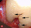 Fig 12. Microislands of calculus are shown on the root surface (arrows on some of the microislands) after scaling with an ultrasonic scaler and sharp hand curettes. This root surface had been judged “clean” when observed with 3.5x loupes. When viewed with the high magnification of the videoscope, the remaining calculus became obvious. Burnishing with EDTA will remove these microislands of calculus.