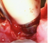 Fig 13. The VMIS technique for treating implants with bone loss incorporates disinfecting the implant surface with only a saline-soaked gauze. The use of acidic disinfecting solutions, such as hydrogen peroxide or tetracycline solutions, is avoided because they cause corrosion of the titanium oxide layer and shedding of titanium particles.