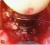 Fig 14. A mixture of demineralized freeze-dried bone allograft and enamel matrix derivative is placed in the osseous defects around implants (shown in photo) or around natural teeth. Care should be taken to not overfill the defect because overfilling can prevent the primary closure of the soft tissue.
