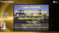 Laser Assisted Peri-Implantitis Procedure: An Alternative to Traditional Surgical Therapy Webinar Thumbnail