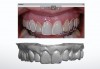 Fig 13. The smile design was synced with the preoperative photograph by overlaying
the blue landmarks.