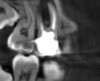 CBCT of the same tooth N o. 14 (palatal
view exposure) shown in Fig 1 definitively shows a periapical lesion.