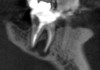 CBCT sagittal view (lingual view exposure) of tooth N o. 18 revealed mesial
and distal root periapical radiolucency.