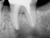Periapical radiograph of tooth
No. 18 immediately after replacement in socket.