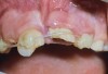 Fig 1. Age 8. Facial view of teeth Nos. 8 and 9 at initial examination.