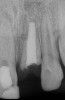 Fig 3. Age 10. Radiograph of teeth Nos. 8 and 9, 3 months after the fractured coronal segment of No. 9 was removed. Note the coronal level of the root relative to tooth No. 10.