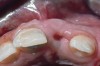 Fig 4. Age 10. Occlusal view of maxillary ridge.