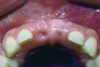 Fig 6. Age 15. Occlusal view of the developing ridge.