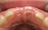 Fig 9. Age 19. Occlusal view. Pressure from a temporary partial denture exposed the sharp coronal edge of No. 9. A comparison of the vertical level (Fig 5 and Fig 8) and horizontal width of the developing maxillary ridge from ages 10 (Fig 4), 15 (Fig 6), and 19 showed much similarity over a nearly 10-year period.