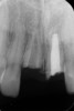Fig 10. Age 19. Radiograph of teeth Nos. 8 and 9. The roots also remained in a similar position relative to the erupting adjacent teeth from ages 10 (Fig 3), 15 (Fig 7), through 19.