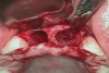 Fig 11. Age 20. Extraction sites with intact labial plates. Their vertical height was near the level of the proximal bone of the adjacent teeth.