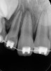 Fig 12. Age 9. Radiograph of teeth Nos. 8 and 9 at initial examination. Orthodontic brackets were placed to stabilize the teeth.