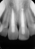 Fig 13. Age 9. Obturation of teeth Nos. 8 and 9.