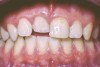 Fig 14. Age 14. Facial view of tooth No. 8 about 2.5 mm in infraocclusion.
