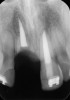 Fig 16. Age 14.5. Radiograph of the remaining root immediately after decoronation.