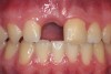 Fig 18. Age 16.5. Facial view of the ridge level and papillae height on the mesial aspects of adjacent teeth.