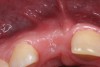Fig 19. Age 16.5. Occlusal view of the ridge and labial enlargement from bone replacing the resorbing root.