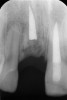 Fig 20. Age 16.5. Radiograph showing the coronal level of the ridge. Root fragments still remained.