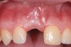 Fig 21. Age 21. Presurgical labial view prior to implant placement.