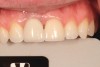 Fig 23. Final restoration at 4 months. A provisional restoration was used to mold the tissue prior to placement of the final restoration.