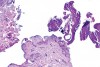 Laser biopsies causing tissue cauterization and artifactual separation of the epithelium from the connective tissue (810 nm, 1 W, continuous wave).