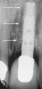 Fig 1. A periapical radiograph of an implant placed in the left central incisor position. The implant has an angulation toward the distal (arrows) to avoid penetration of the nasopalatine canal.