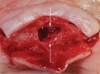 Fig 5. Intraoral occlusal view of the height disparity between the labial and palatal bony margins of the nasopalatine foramen (arrows).