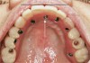Fig 6. Intraoral occlusal view of a completed fixed implant prosthesis. Multiple short and narrow-diameter implants were placed into grafted bone, plus one implant was inserted into the previously grafted nasopalatine canal. Note the 5-mm to 7-mm horizontal disparity between the center of the implant (arrow) and the facial of the prosthetic teeth (black line). This patient did not report any phonetic issues after prosthesis insertion.