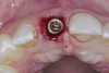 Fig 2. Immediate implant placement.