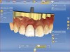 Fig 3. Provisional restoration design using “biocopy” function of the CAD/CAM software.