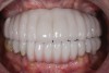 Fig 8. Preoperative intraoral photograph. Full-arch restoration was mobile and unesthetic.