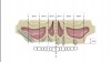 Fig 1. As shown on the right side of this illustration, when there is
moderate alveolar resorption with more than 6 mm of alveolar height
(and sufficient width), short dental implants often can be placed in the
premolar/molar region below the maxillary sinus. In the anterior maxilla,
short implants may be placed superiorly (following ostectomy) where
there is sufficient width for standard-diameter implants. As shown on the
left side of this illustration, when there is severe alveolar resorption with
less than 5 mm of alveolar bone beneath the sinus, several nongrafting
solutions are available, including the use of zygomatic implants or tilting
of distal implants along the anterior sinus wall. A third option (not shown)
is the use of pterygoid implants. (Adapted from Krekmanov et al<sup>22</sup> and
Bedrossian and Bedrossian<sup>23</sup>)