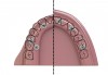 Fig 2. As shown on the right side of this illustration,
the placement of short implants may enable the implants to be
well-oriented to the cingulum or occlusal fossae of associated teeth. As
shown on the left side of this illustration, a common challenge in treating
the severely resorbed maxilla is the centripetal movement of the implants
relative to teeth. Anterior implant placement can challenge phonetics and
esthetics (arrow 1). Zygomatic implant placement can result in palatal
location of the implant that results in impingement of the prosthesis in
the palatal region and creation of hygiene challenges (arrow 2). The distal
tilting of implants along the anterior sinus wall also follows the flaring
buccal wall of the maxilla; without attention to this detail, marked buccal
implant orientation may occur. Fortunately, angled abutments can readily
accommodate this buccal implant orientation (arrow 3). (Adapted from
Krekmanov et al<sup>22</sup> and Bedrossian and Bedrossian<sup>23</sup>)