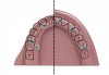 Fig 2. As shown on the right side of this illustration,
the placement of short implants may enable the implants to be
well-oriented to the cingulum or occlusal fossae of associated teeth. As
shown on the left side of this illustration, a common challenge in treating
the severely resorbed maxilla is the centripetal movement of the implants
relative to teeth. Anterior implant placement can challenge phonetics and
esthetics (arrow 1). Zygomatic implant placement can result in palatal
location of the implant that results in impingement of the prosthesis in
the palatal region and creation of hygiene challenges (arrow 2). The distal
tilting of implants along the anterior sinus wall also follows the flaring
buccal wall of the maxilla; without attention to this detail, marked buccal
implant orientation may occur. Fortunately, angled abutments can readily
accommodate this buccal implant orientation (arrow 3). (Adapted from
Krekmanov et al<sup>22</sup> and Bedrossian and Bedrossian<sup>23</sup>)