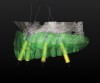 Fig 4. Tilted implants offer a simplified treatment plan for the edentulous maxilla. Fig 3:
CBCT planning is shown of an edentulous maxilla with sufficient bone in zones 1, 2, and 3 for axial
implant placement in the sinus region. A six-implant plan for support of a fixed implant prosthesis
was proposed. Fig 4: An alternative CBCT planning for the same edentulous maxilla is shown
using four tilted implants. N ote that the implant orientation provides for sufficient anteriorposterior
spread that approximates the six-implant solution.