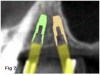 Fig 7. Tilted implant solutions for maxillary posterior partial edentulism. In the same manner that tilted implants can be used to
avoid the need for sinus grafting in full-arch implant prostheses, they can be used to avoid direct or indirect sinus grafting when insufficient posterior
maxillary bone volume challenges a fixed dental prosthesis implant restoration. Fig 7: Software planning for implant placement is shown with
tilting of the distal implant along the anterior wall of the maxillary sinus where there is insufficient bone in zone 3. Fig 8: Postoperative radiograph
of the implants and abutments reveals the angulation of the implant resolved by the CAD/CAM abutment. Fig 9: Final radiograph of the implant
prosthesis following restorations demonstrates the inclusion of a tooth in the molar position without sinus grafting.