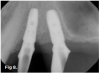Fig 8. Tilted implant solutions for maxillary posterior partial edentulism. In the same manner that tilted implants can be used to
avoid the need for sinus grafting in full-arch implant prostheses, they can be used to avoid direct or indirect sinus grafting when insufficient posterior
maxillary bone volume challenges a fixed dental prosthesis implant restoration. Fig 7: Software planning for implant placement is shown with
tilting of the distal implant along the anterior wall of the maxillary sinus where there is insufficient bone in zone 3. Fig 8: Postoperative radiograph
of the implants and abutments reveals the angulation of the implant resolved by the CAD/CAM abutment. Fig 9: Final radiograph of the implant
prosthesis following restorations demonstrates the inclusion of a tooth in the molar position without sinus grafting.