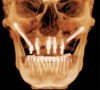 Fig 10 through Fig 12. Representative examples of the use of zygomatic implants for rehabilitation of the severely resorbed maxilla. Fig 10:
Zygomatic implants placed for posterior prostheses support in the absence of sufficient bone in zones 1 and 2 are combined with conventional anterior
implants. Fig 11: Quad zygomatic implants are placed for support of the maxillary prosthesis in the absence of sufficient bone in zones 1, 2, and
3. Fig 12: The unilateral absence of bone in zones 1, 2, and 3 is addressed using unilateral quad zygomatic and conventional implants contralaterally.