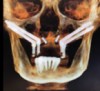 Fig 11. Representative examples of the use of zygomatic implants for rehabilitation of the severely resorbed maxilla. Fig 10:
Zygomatic implants placed for posterior prostheses support in the absence of sufficient bone in zones 1 and 2 are combined with conventional anterior
implants. Fig 11: Quad zygomatic implants are placed for support of the maxillary prosthesis in the absence of sufficient bone in zones 1, 2, and
3. Fig 12: The unilateral absence of bone in zones 1, 2, and 3 is addressed using unilateral quad zygomatic and conventional implants contralaterally.